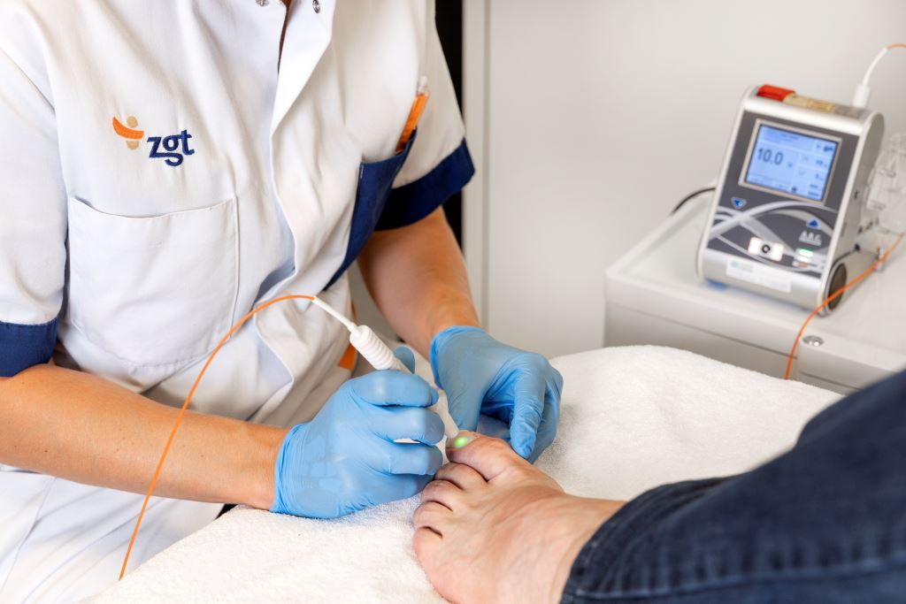 FOX laser: laser voor schimmelnagels