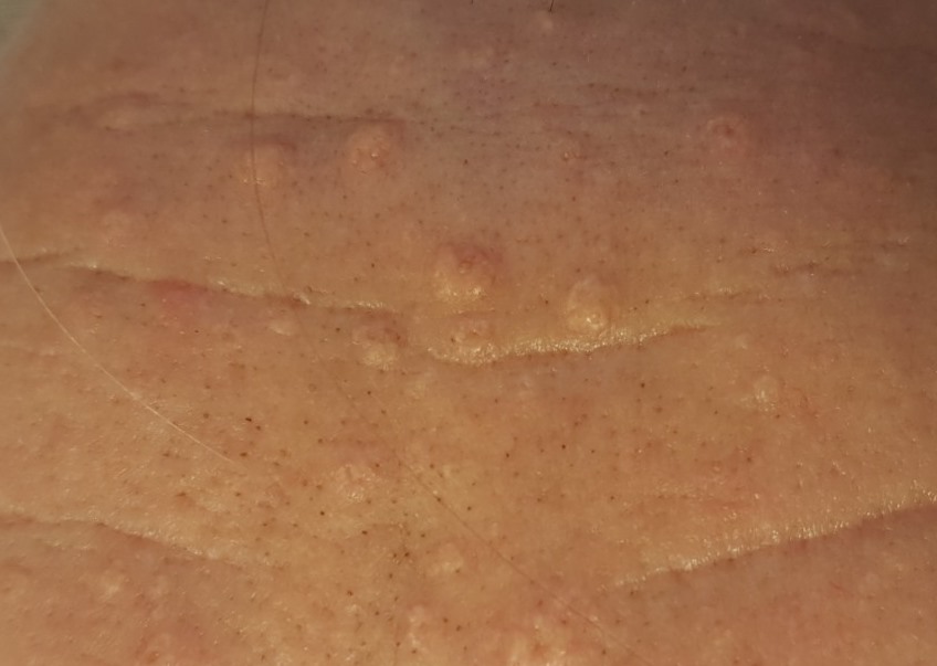 Histologie Van De Talgklier Talgklier Hyperplasie vergrote Histologie Van De Talgklier Talgklier Hyperplasie vergrote