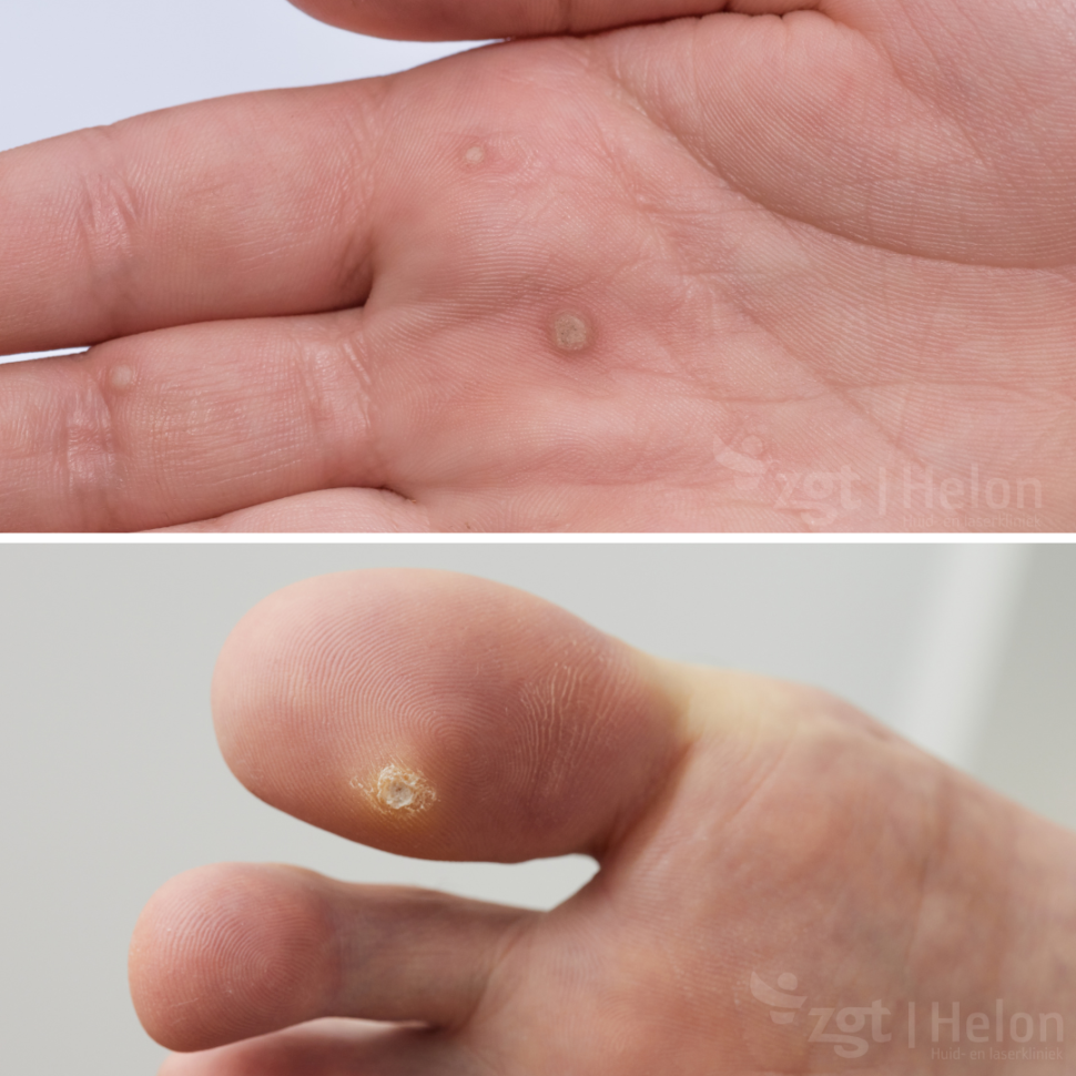 Wratten effectief verwijderen? ZGT Helon Huidkliniek & Laserkliniek