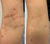 Voor en na vaatlaserbehandeling littekens na kwallenbeet