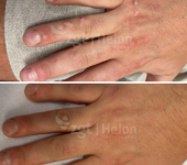 Voor en na vaatlaserbehandeling wratten op de handen (verruca vulgaris)